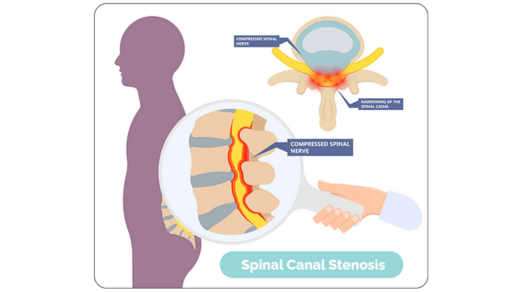 spinal stenosis treatment